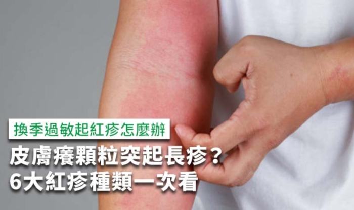 中藥過敏紅疹症狀 中藥過敏紅疹症狀