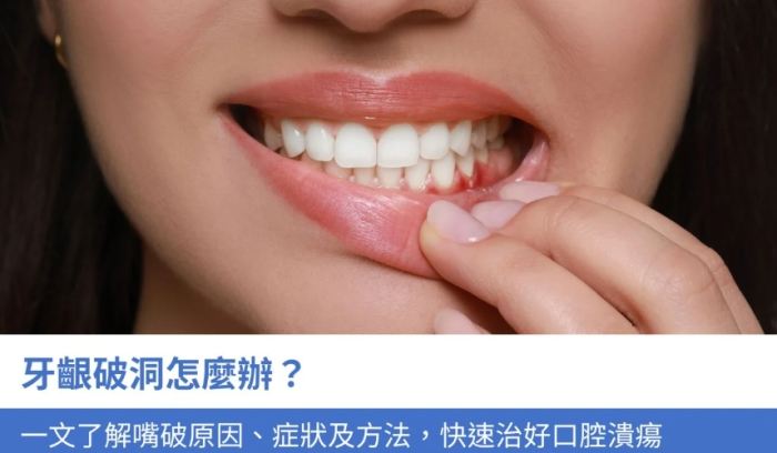 嘴破治療