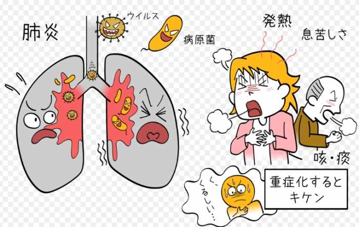 肺炎治療 肺炎治療