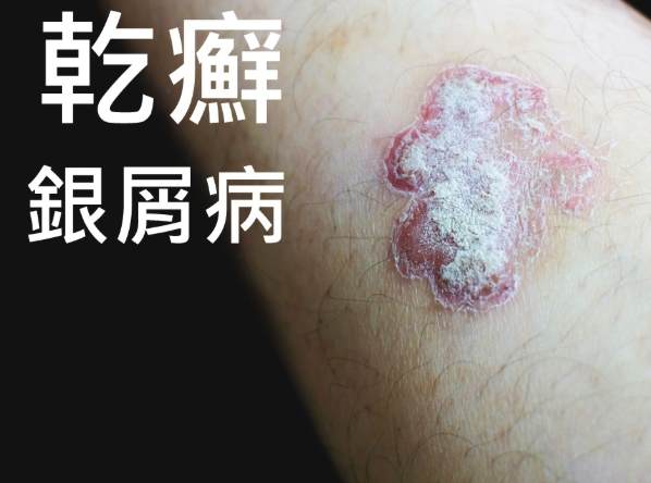 指甲乾癬治療