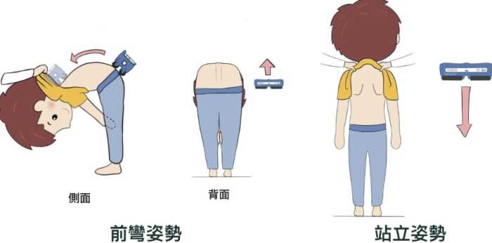 脊椎側彎治療 脊椎側彎治療