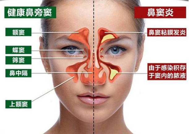 慢性鼻竇炎症狀 慢性鼻竇炎症狀