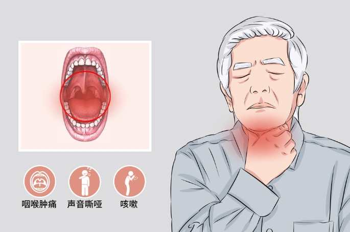 急性咽喉炎 自愈 急性咽喉炎 自愈