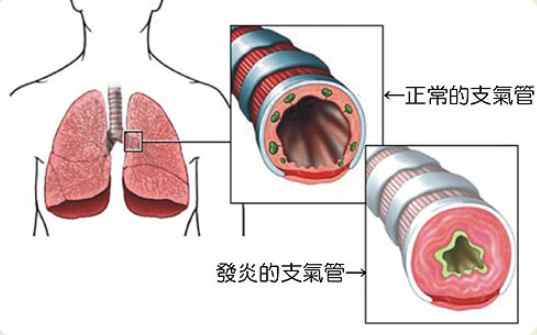 支氣管炎症狀治療 支氣管炎症狀治療