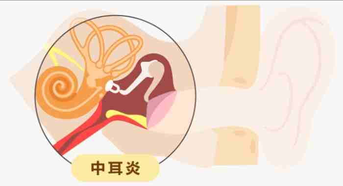 大人中耳炎