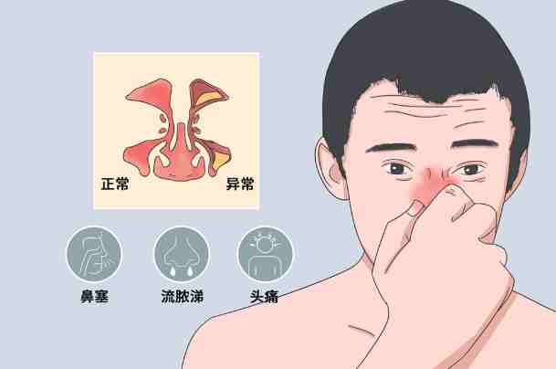鼻竇炎症狀 鼻竇炎症狀