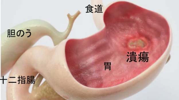 胃潰瘍治療時間 胃潰瘍治療時間