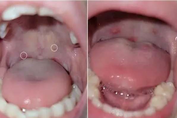 腸病毒症狀 腸病毒症狀
