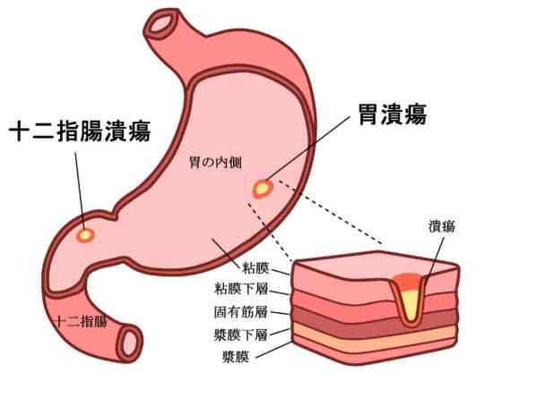 十二指腸潰瘍治療時間 十二指腸潰瘍治療時間