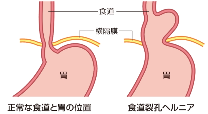 中醫治療胃食道逆流 中醫治療胃食道逆流