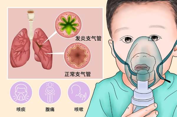 慢性支氣管炎症狀 慢性支氣管炎症狀