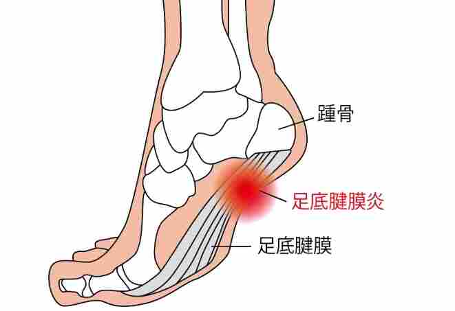 足底筋膜炎恢復時間 足底筋膜炎恢復時間