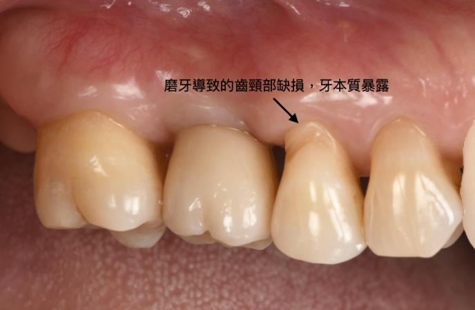 敏感性牙齒治療
