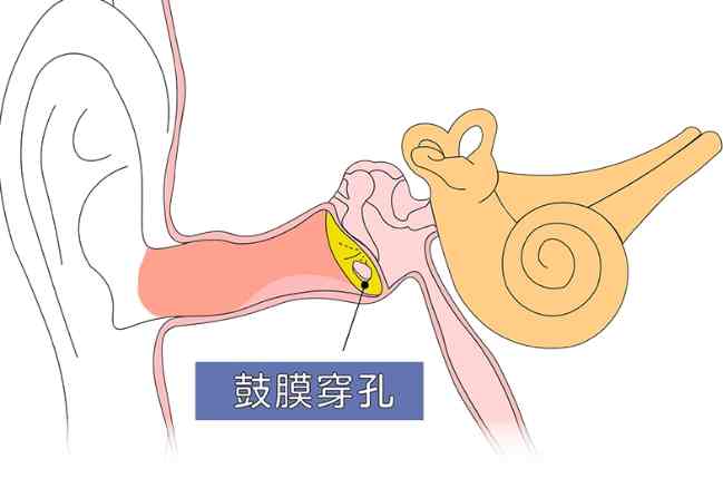 大人中耳炎症狀 大人中耳炎症狀