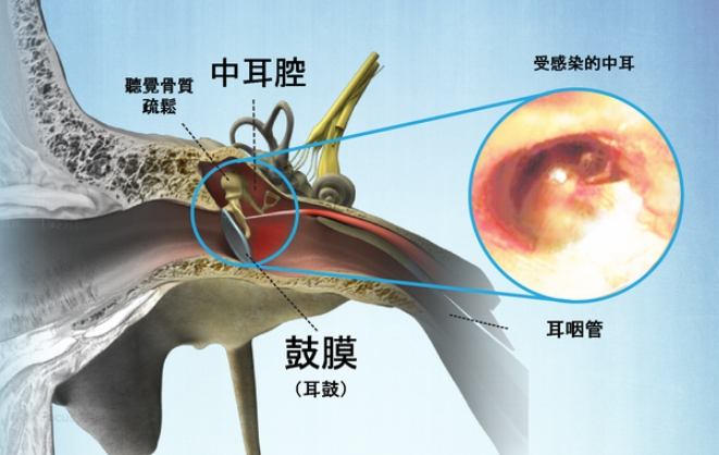 中耳炎恢復時間 中耳炎恢復時間