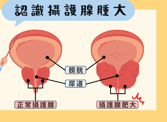 攝護腺手術風險 攝護腺手術風險