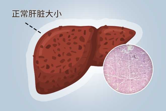 肝硬化治療 肝硬化治療