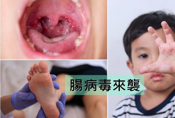 腸病毒口腔潰瘍