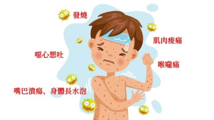 腸病毒水泡