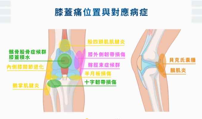 膝蓋痛治療