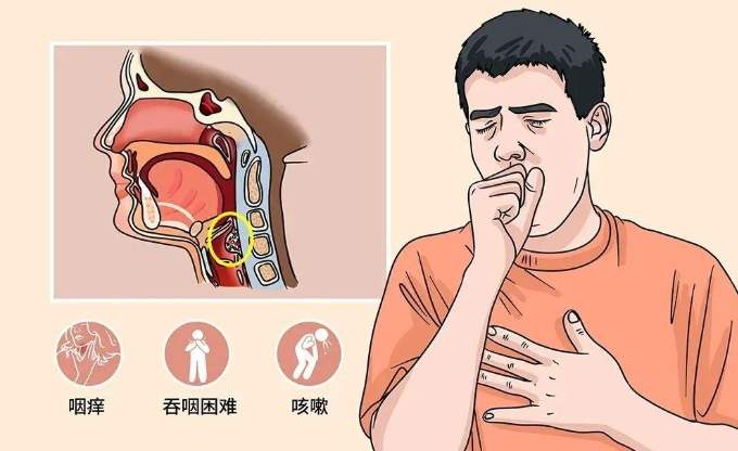 咽喉炎症狀 咽喉炎症狀