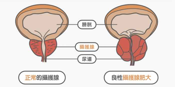 攝護腺肥大藥物副作用 攝護腺肥大藥物副作用