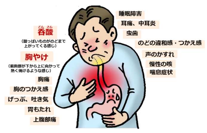 胃食道逆流喉嚨痛