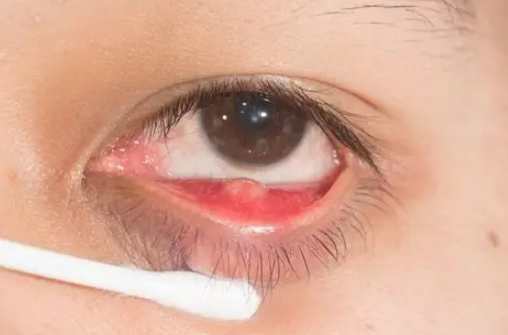 霰粒腫恢復時間 霰粒腫恢復時間