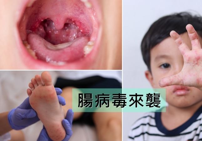 腸病毒嘴破 腸病毒嘴破