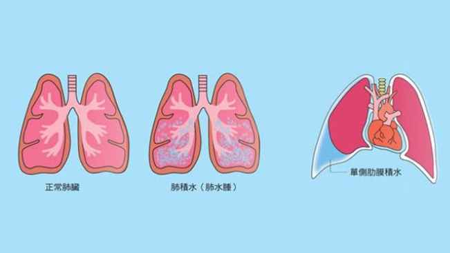 肺積水治療 肺積水治療