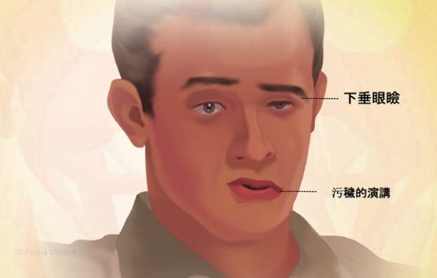 重症肌無力治療