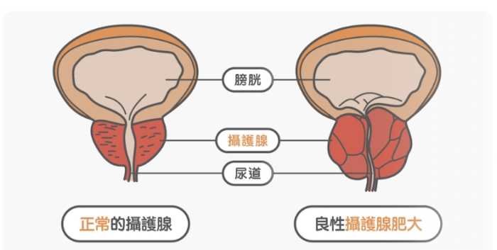 攝護腺肥大藥物治療 攝護腺肥大藥物治療