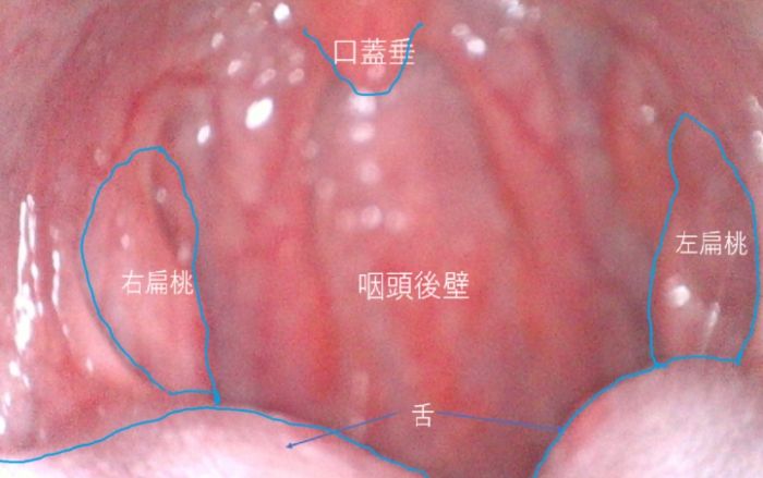 兒童扁桃腺炎症狀