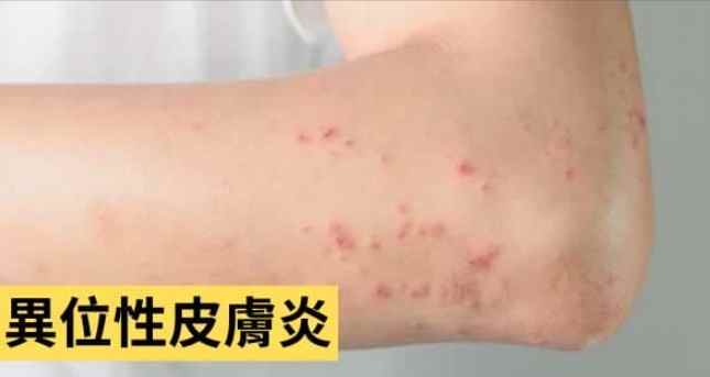 異味性皮膚炎治療