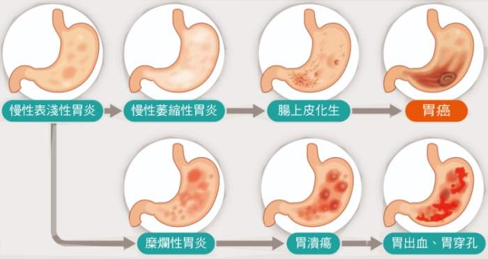 胃炎恢復時間 胃炎恢復時間