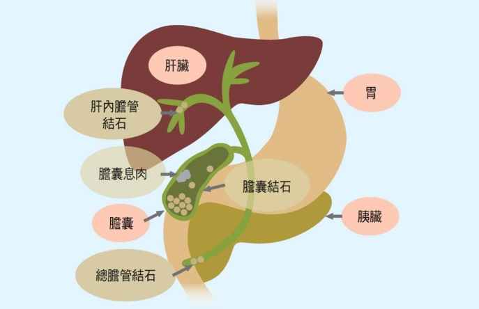 膽結石自然排出方法 膽結石自然排出方法