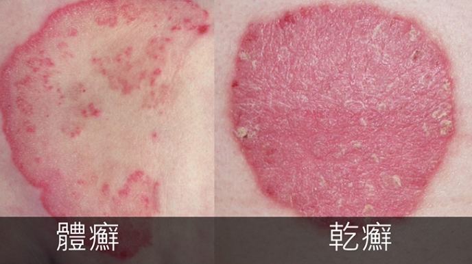 乾癬治療 乾癬治療