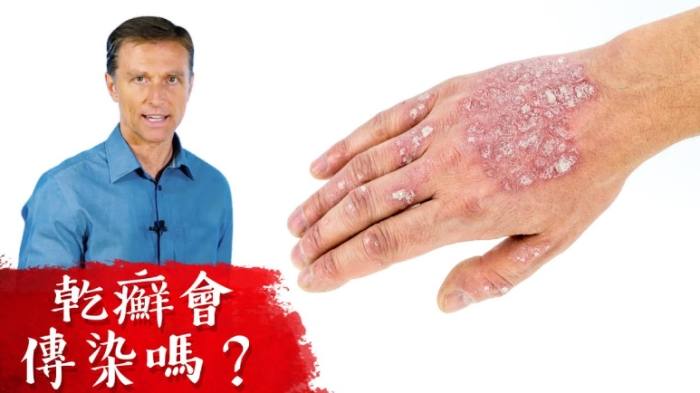 指甲乾癬成因 指甲乾癬成因