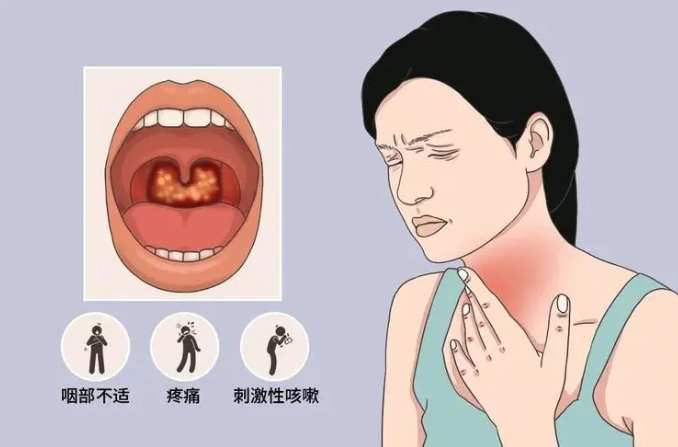 慢性咽喉炎治療 慢性咽喉炎治療