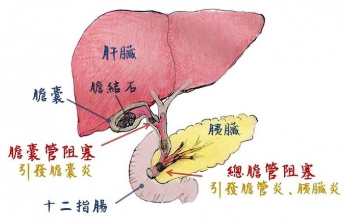 膽結石手術 膽結石手術