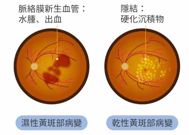 黃斑部病變治療 黃斑部病變治療