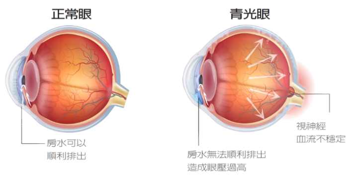 青光眼治療