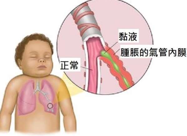 兒童支氣管炎恢復時間 兒童支氣管炎恢復時間