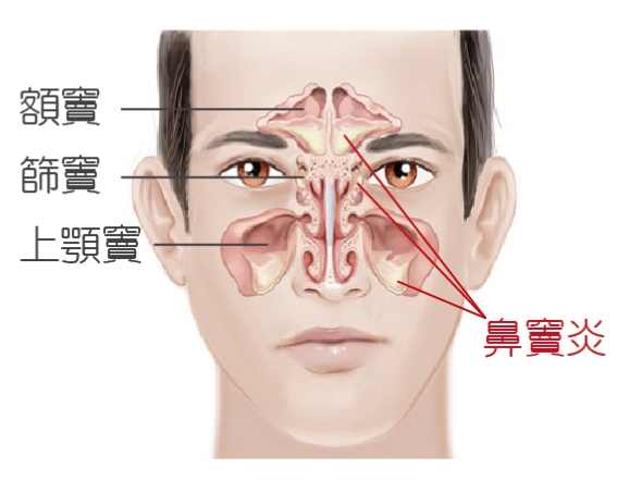 鼻竇炎恢復時間 鼻竇炎恢復時間