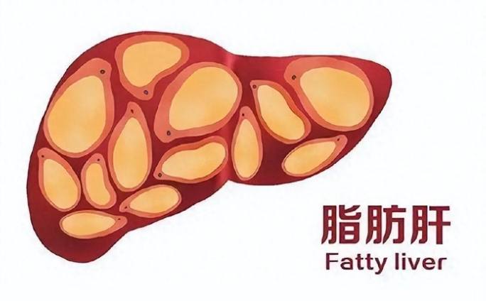 脂肪肝飲食