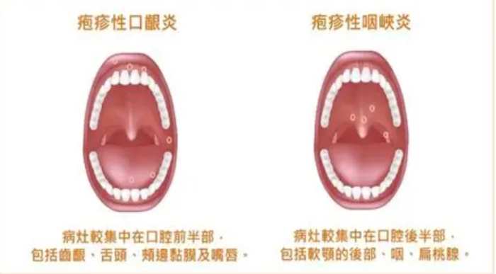 腸病毒症狀 腸病毒症狀