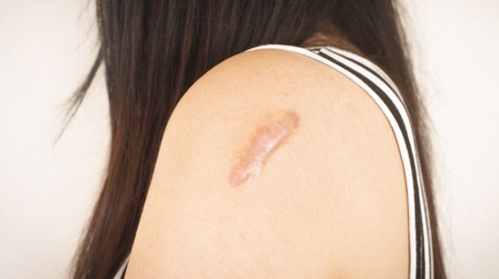蟹足腫治療 蟹足腫治療