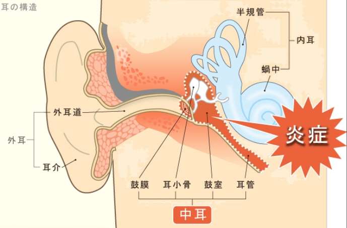 大人中耳炎 大人中耳炎