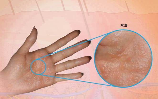 汗皰疹 自愈