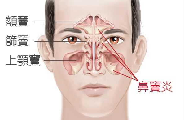 慢性鼻竇炎治療 慢性鼻竇炎治療